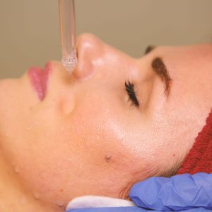 Jet Peel tretman